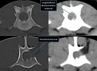 CT-Aufnahme eines Bandscheibenvorfalls bei einer Französischen Bulldogge, zur Operationsplanung