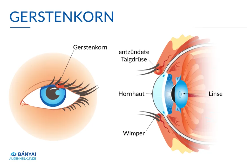 Definition und Erscheinungsbild eines Gerstenkorns am Auge