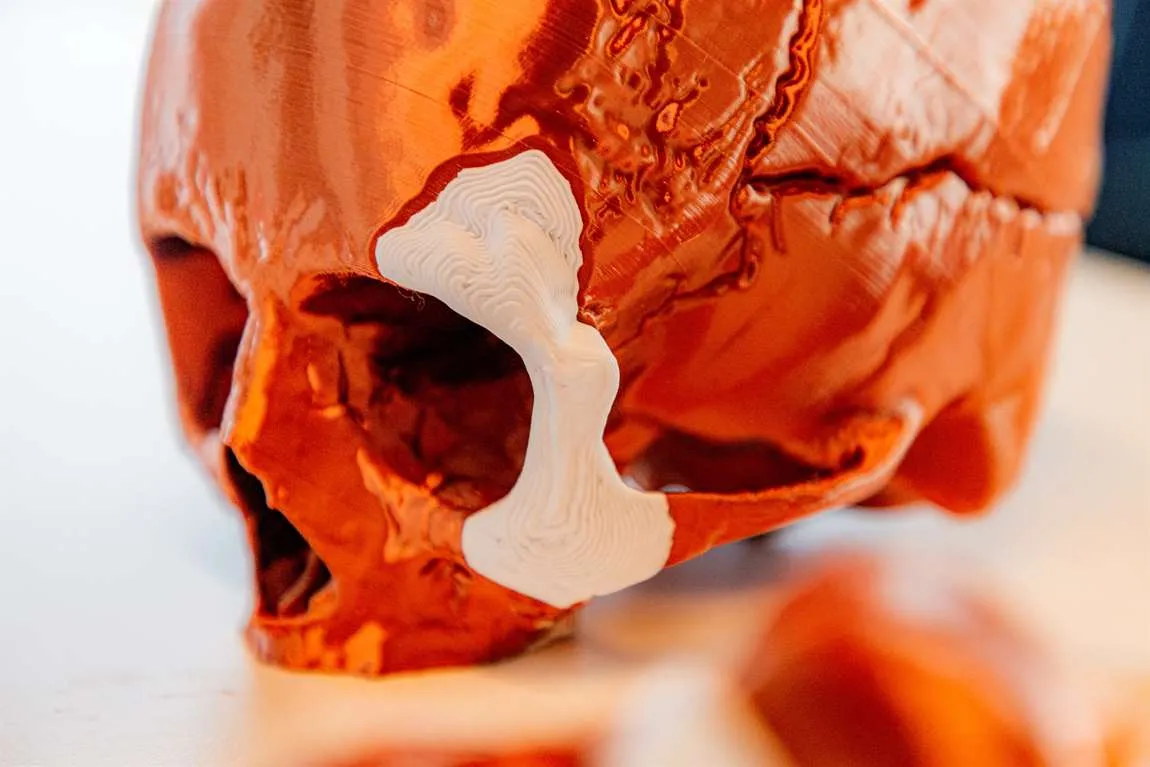 Ein 3D-gedrucktes Knochenimplantat auf einem Modell des menschlichen Knochens