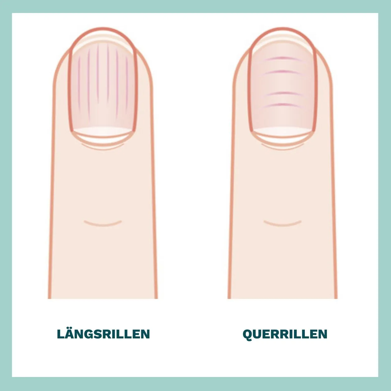 Eine schematische Darstellung, wie Rillen in Fingernägeln aussehen können, wobei zwischen Längs- und Querrillen unterschieden wird.