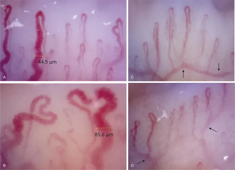Kapillaroskopische Befunde: Venöse Dilatation und prominenter Plexus