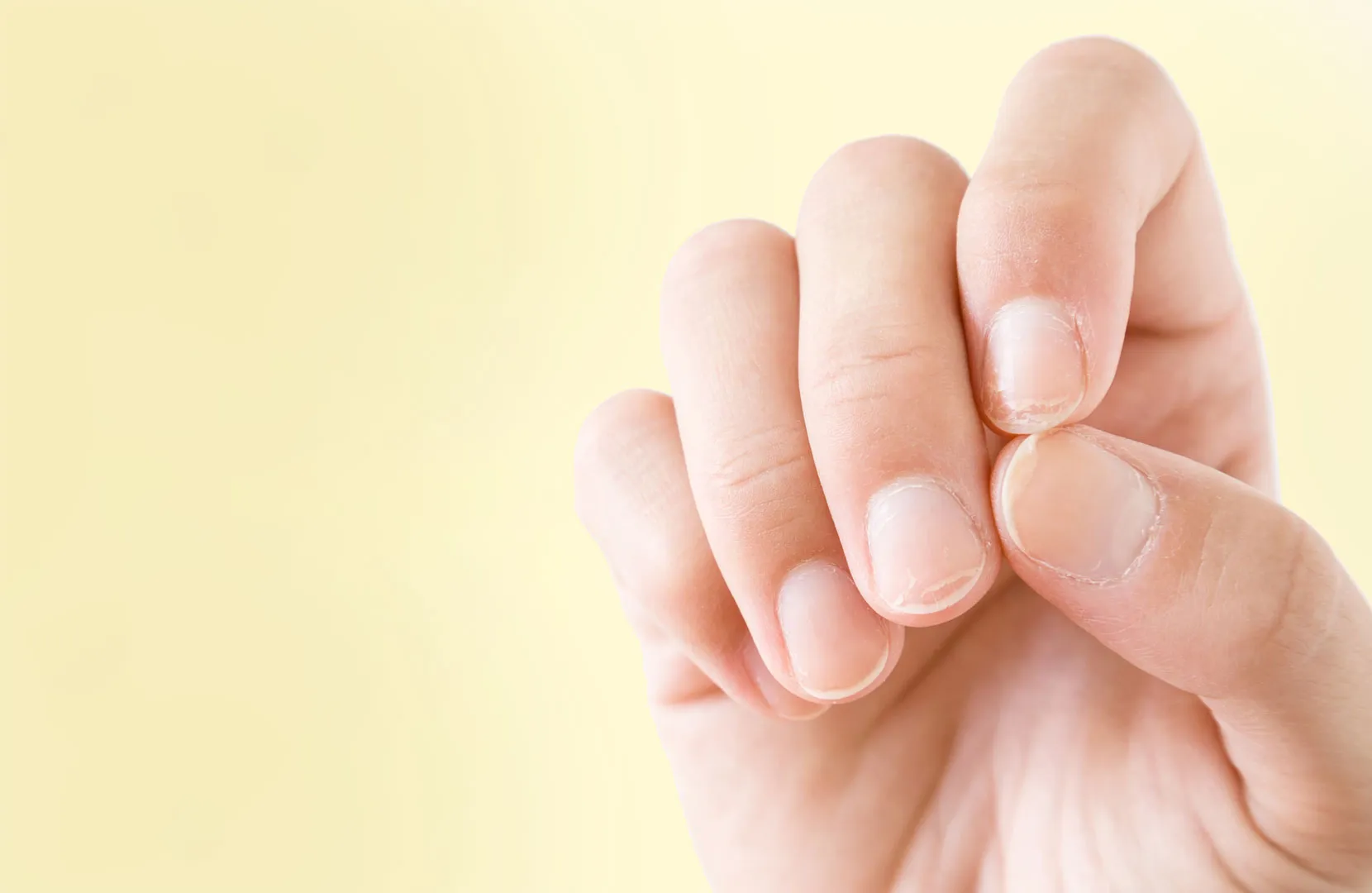 Nahaufnahme von Fingernägeln mit sichtbaren Querrillen.