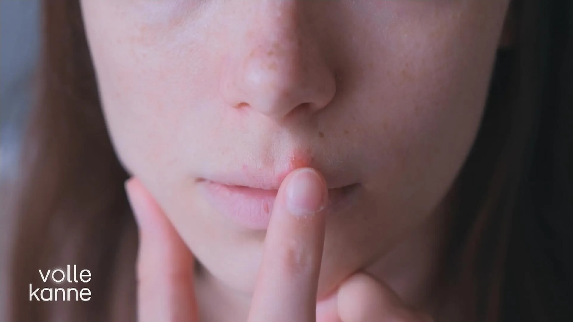 Nahaufnahme von Lippenherpesbläschen auf der Lippe einer Person