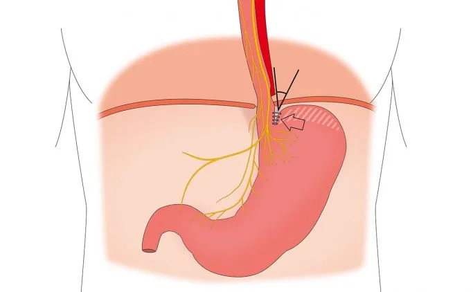 Schema der Bicorn-Methode