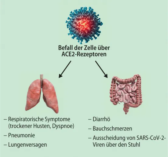 Grafik einer schematischen Darstellung des Zusammenspiels von COVID-19 und chronisch entzündlichen Darmerkrankungen
