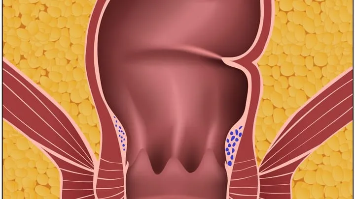 Schweregrad 1: Die leicht vergrößerten Gefäßpolster (in der Grafik blau) sind nur per Darmspiegelung zu erkennen.