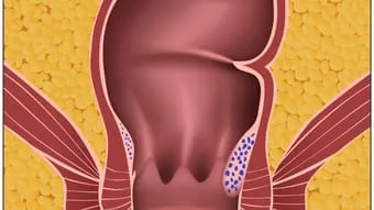 Schweregrad 2: Beim Pressen wölben sich die Hämorrhoidalknoten (in der Grafik blau) nach außen, danach ziehen sie sich aber wieder zurück.